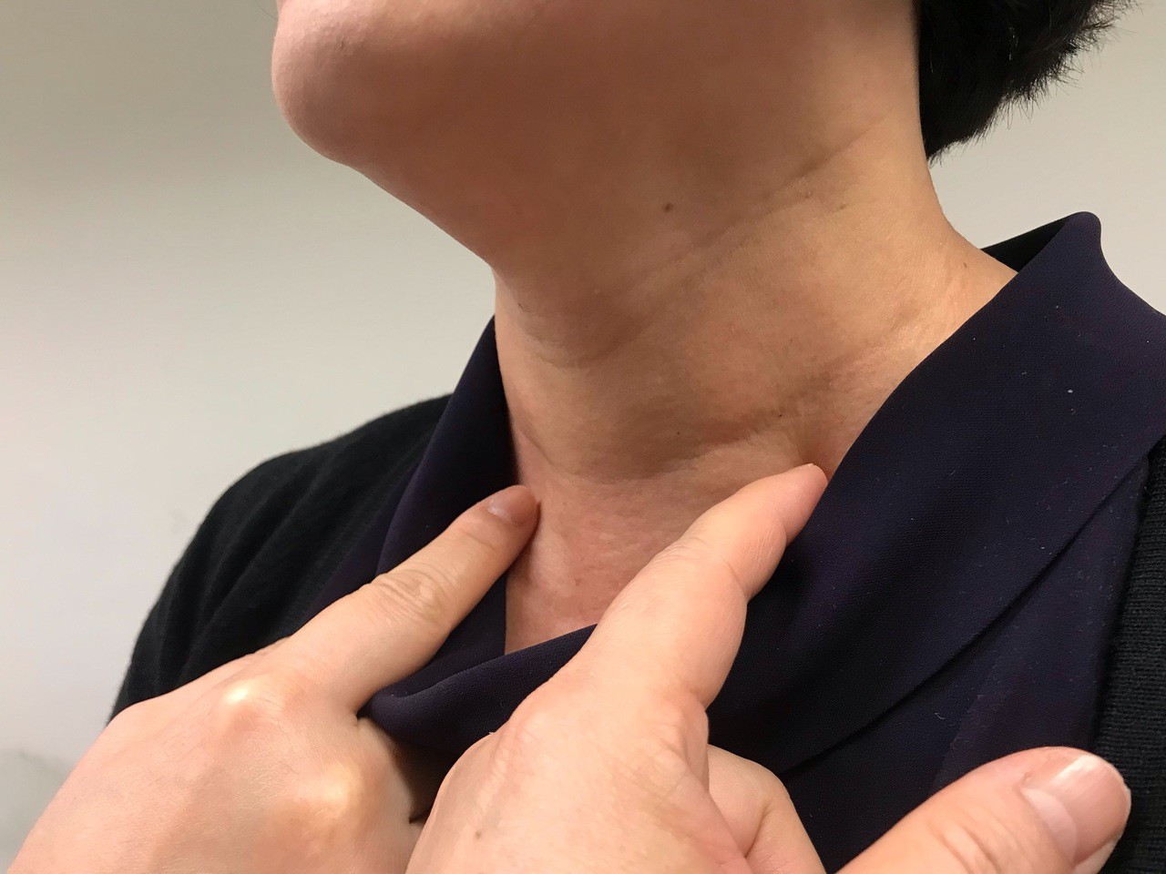 不痛就沒事？脖子腫脹「摸出一串葡萄」竟是癌　愣住「沒感覺有怪怪的」醫師搖頭嘆：6症狀早出現