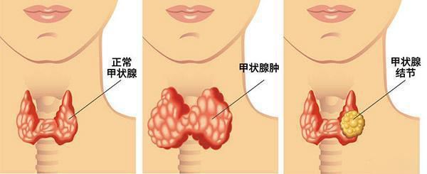 完全沒症狀！30歲女子「確診甲狀腺癌」她震驚：沒家族病史　醫生示警「出現此徵兆快就醫」