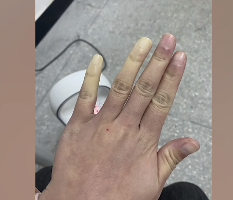 一到冬天就手腳冰涼！女教師曬「手部照片」抱怨　「醫學生一看」連忙喊話：趕快去醫院