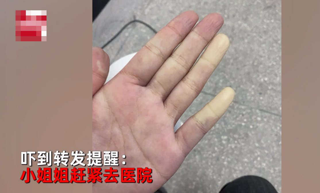一到冬天就手腳冰涼！女教師曬「手部照片」抱怨　「醫學生一看」連忙喊話：趕快去醫院