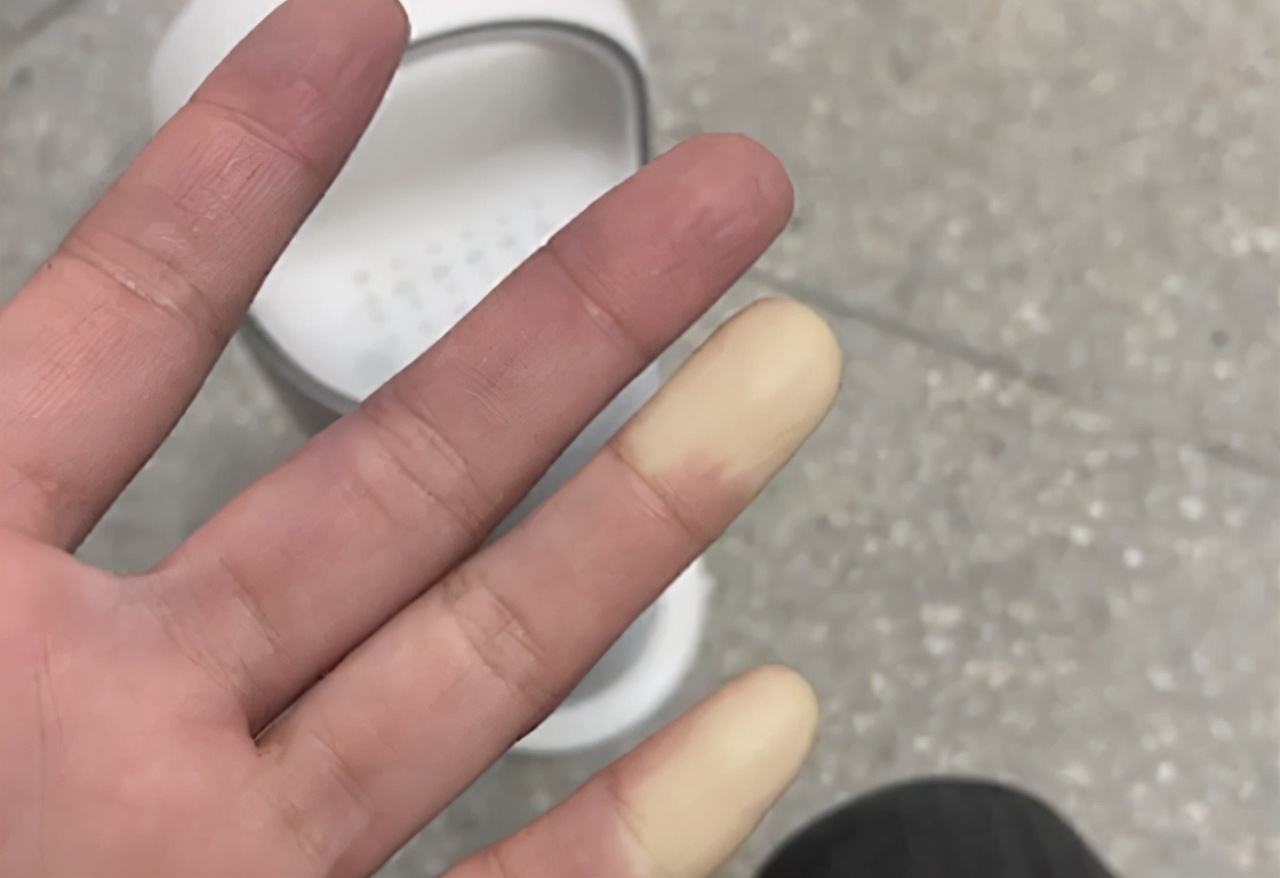 一到冬天就手腳冰涼！女教師曬「手部照片」抱怨　「醫學生一看」連忙喊話：趕快去醫院