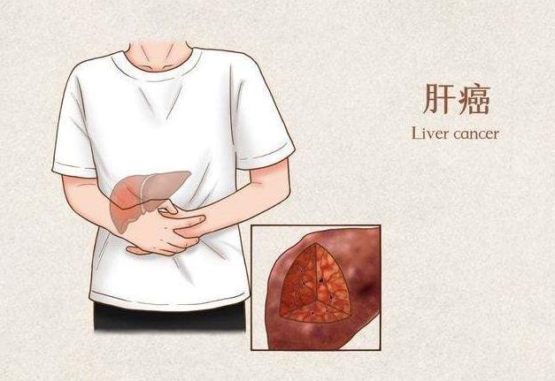  每天排便6次！25歲女身體異常「檢查已是晚期」  醫生：如廁時若有3個症狀「小心自己的肝」