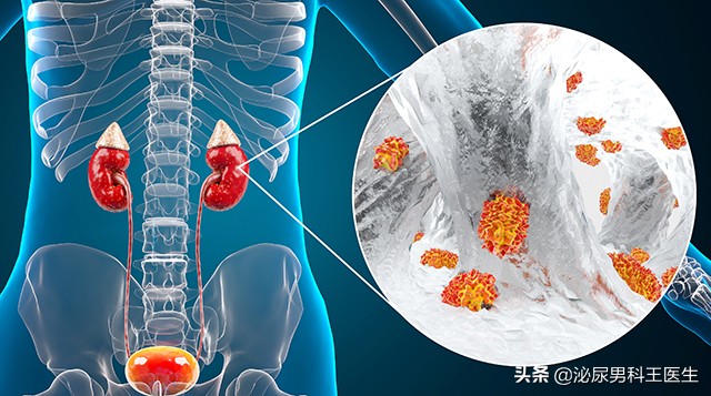 28歲男子確診!為什麼「尿毒症」越來越多?醫生勸告:3個「壞習慣」最好別碰:腎會感謝你