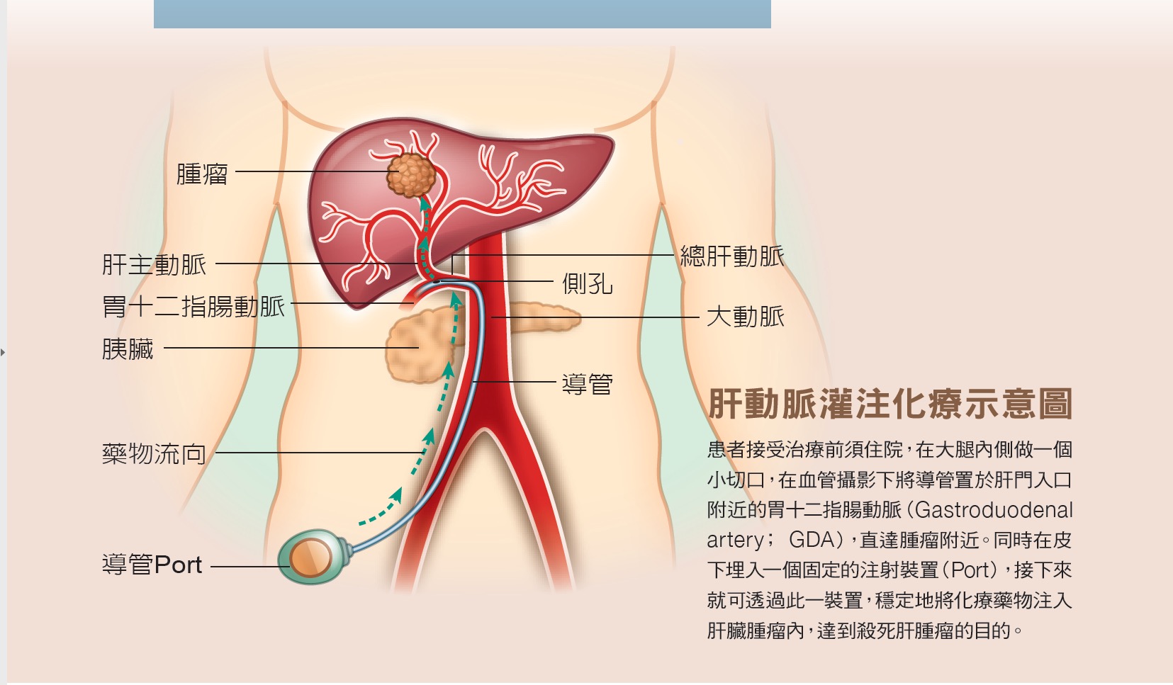 女兒細心觀察救母一命！退休婦手掌驚現紅斑 及早發現肝癌成功治療