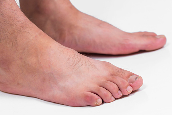 血糖升高「看腳」就知道？腳部「出現3種變化」提醒你儘早就醫檢查　年齡超過45歲尤其要注意