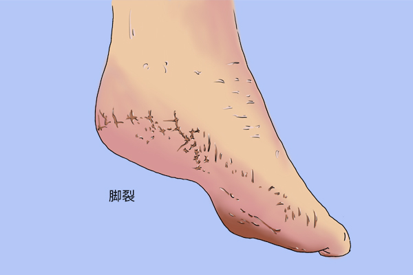 血糖升高「看腳」就知道？腳部「出現3種變化」提醒你儘早就醫檢查　年齡超過45歲尤其要注意