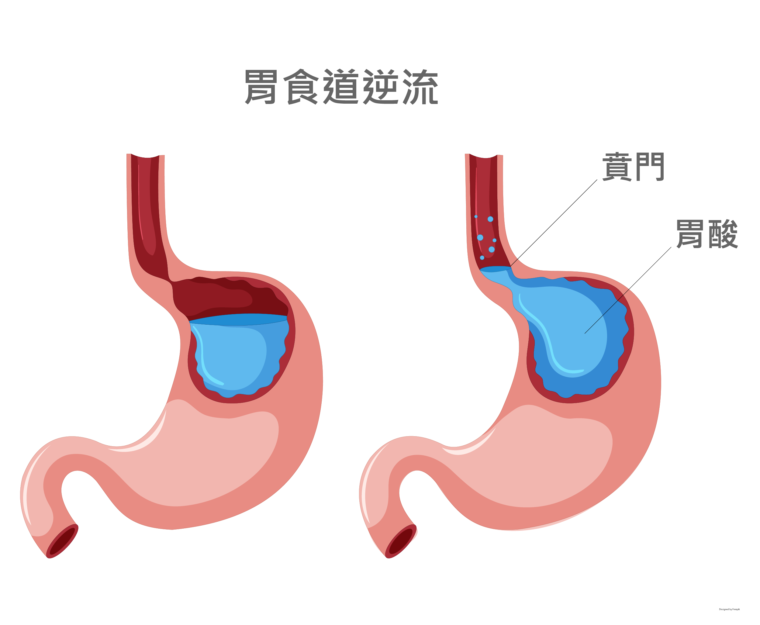 吃東西就吐！30歲女「自認胃食道逆流」求診半年都沒好　醫一查傻眼「根本完全相反」苦嘆：自作聰明