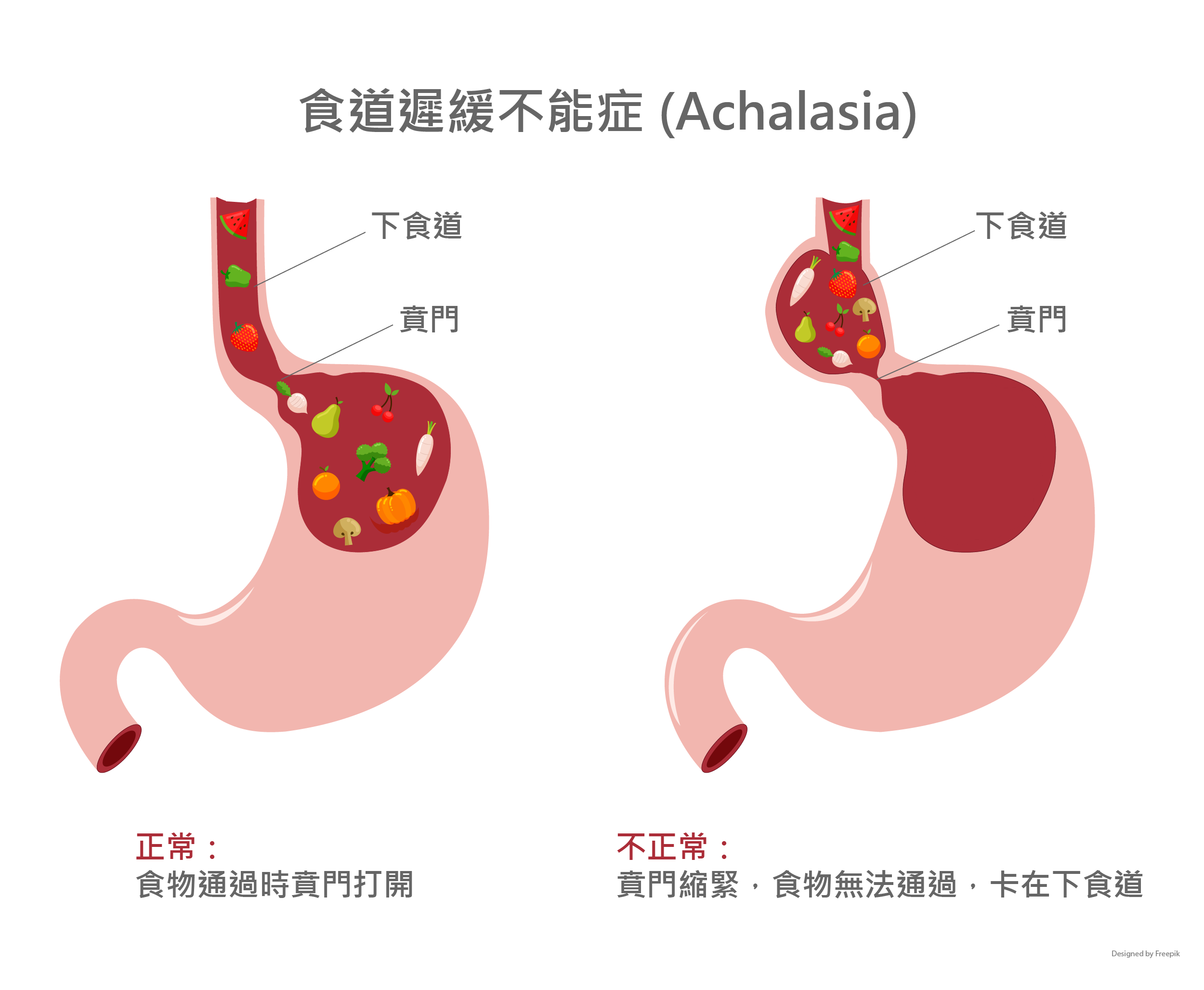 吃東西就吐！30歲女「自認胃食道逆流」求診半年都沒好　醫一查傻眼「根本完全相反」苦嘆：自作聰明