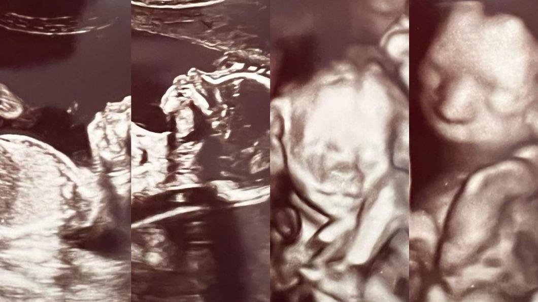 以為是懷雙胞胎！醫生幫她照超音波「疑惑緊盯螢幕」　走出房間驚呼「千萬分之1的奇蹟」全場嚇傻