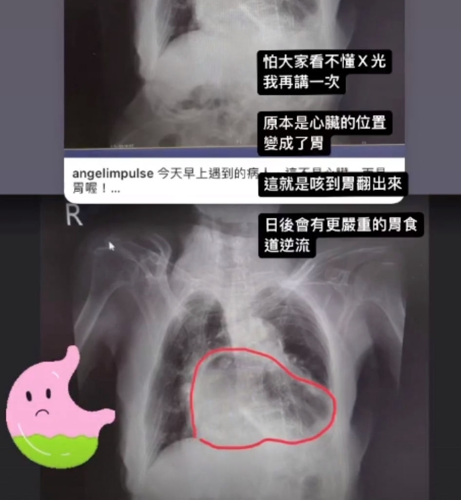 胸悶吃不下！阿嬤照X光「胃部位置怪怪的」嚇壞：吃掉心臟了　揭病因「非短時間造成」再拖恐癌變