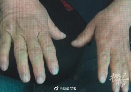 帶孫子去吃麵！陌生鄰桌「猛盯婦人一直看」急勸：快去醫院　一檢查「結果讓她嚇壞」3徵兆沒注意