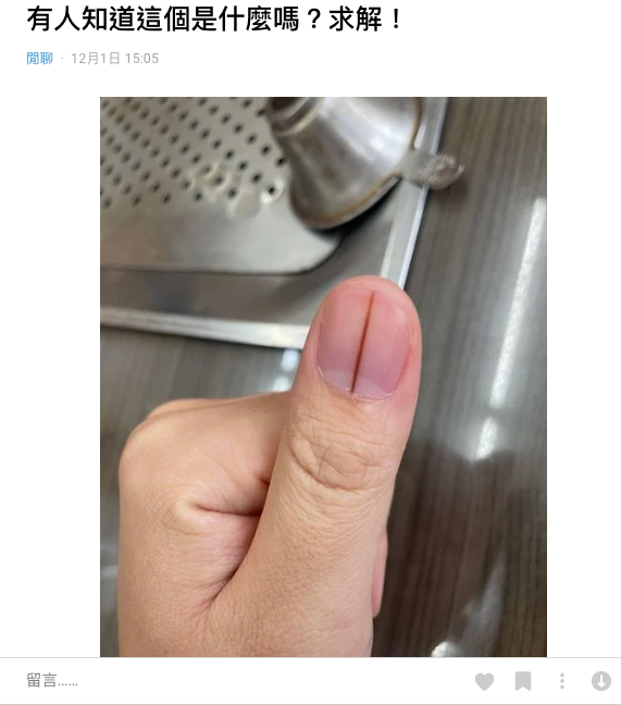 大拇指上出現「神秘筆直黑線」！　男大生好奇問「這個是什麼？」過來人嚇喊：趕快去醫院