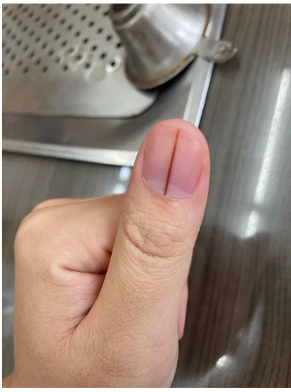 大拇指上出現「神秘筆直黑線」！　男大生好奇問「這個是什麼？」過來人嚇喊：趕快去醫院