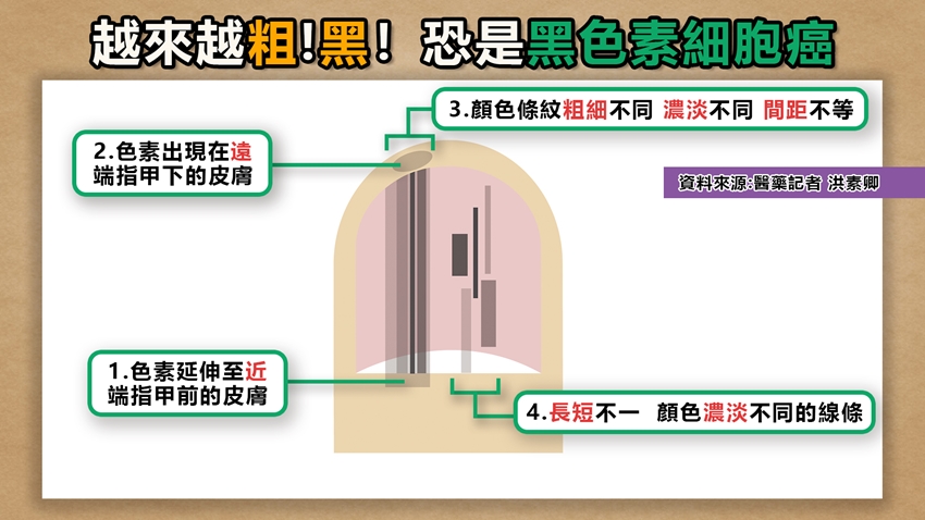 大拇指上出現「神秘筆直黑線」！　男大生好奇問「這個是什麼？」過來人嚇喊：趕快去醫院