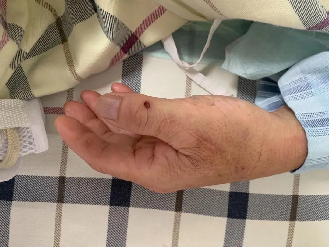 男子處理豬肉差點沒命！只因「一個致命疏忽」　做菜的人都會犯：太常見了