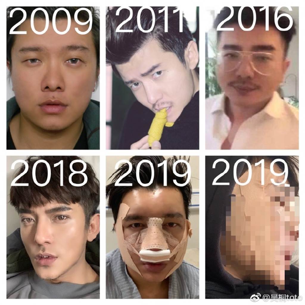 狂吸90萬粉！大叔網紅花10年整形「帥到撞臉金城武」　過往長相曝光「網全認不出」