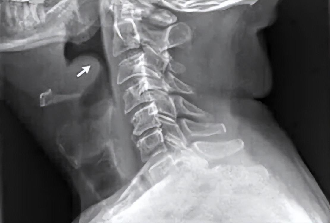 可怕!26歲女半夜吃火鍋「凌晨喉嚨痛」10小時後去世 醫生說「她是被憋死的」