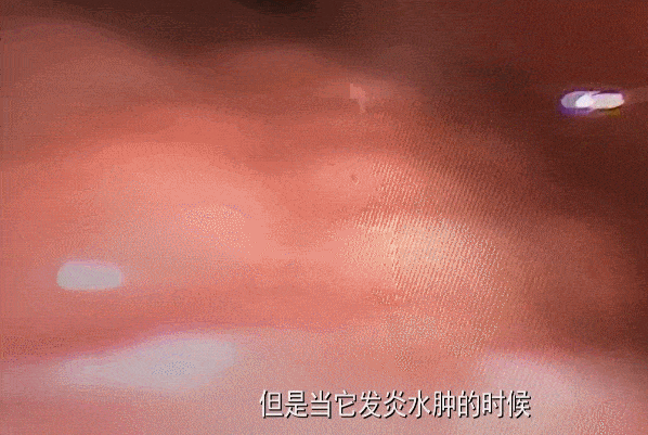 可怕!26歲女半夜吃火鍋「凌晨喉嚨痛」10小時後去世 醫生說「她是被憋死的」