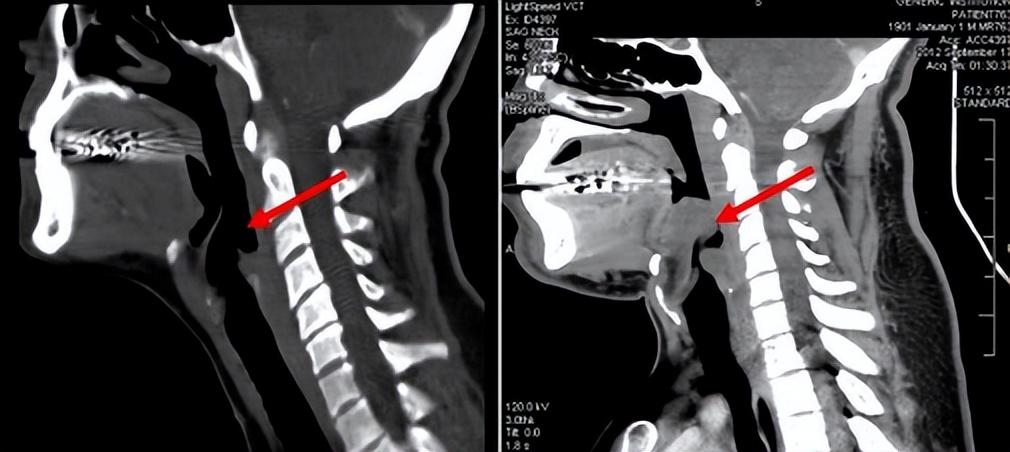 可怕!26歲女半夜吃火鍋「凌晨喉嚨痛」10小時後去世 醫生說「她是被憋死的」