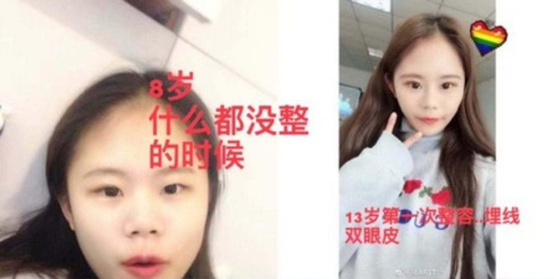 13歲迷上整形！她花千萬整上百次「變白皙大眼蛇精妹」　曬出「最原始樣貌」呼籲：真的別學我