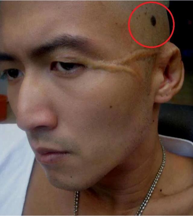 不是找王菲！43歲謝霆鋒「自爆罹皮膚癌」緊急開刀　竟打給張柏芝「她接通一開口」網全怒了：太過分