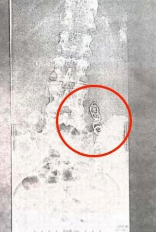 4寶媽跑去結紮！10年間「痛到走不了路」頻吃止痛藥　「超音波畫面曝光」醫生嚇壞：裡面有東西