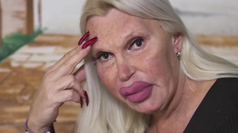 她砸230萬「整成厚嘴唇大媽」嚇壞全球！公開以前模樣「原本是挺鼻美男子」家人氣到不往來