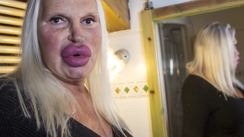 她砸230萬「整成厚嘴唇大媽」嚇壞全球！公開以前模樣「原本是挺鼻美男子」家人氣到不往來