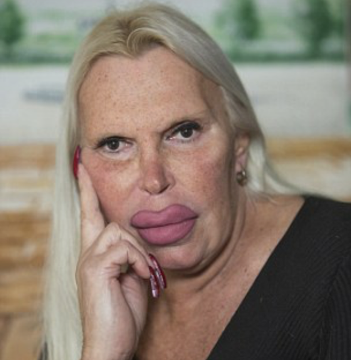 她砸230萬「整成厚嘴唇大媽」嚇壞全球！公開以前模樣「原本是挺鼻美男子」家人氣到不往來