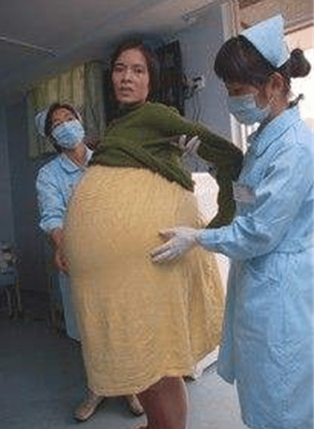 女子懷胎12月未生！老公一看「嚇逃走了」　醫生搖頭「被留在這等死」