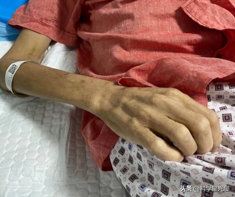 皮膚整片潰爛！71歲母親骨癌晚期「疼得一心求解脫」　女兒強行餵飯「哭求別咽氣」掀兩派網友論戰