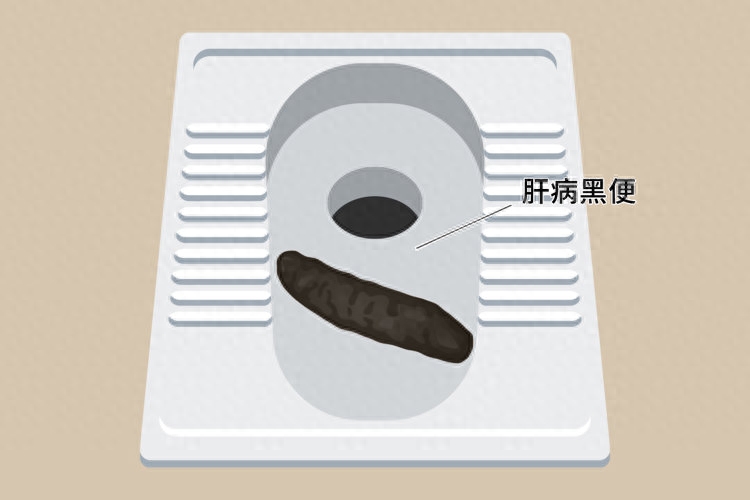 肝癌一發現「就是晚期」？上廁所時出現「3個異常」　醫生建議：儘早排查肝病