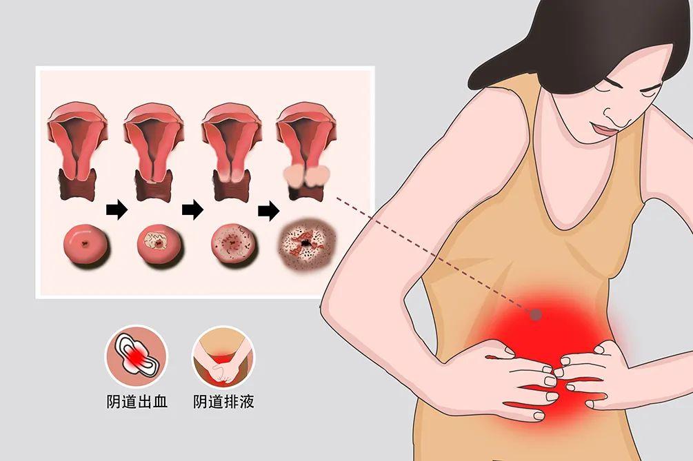 55歲女子長期腿痛！查出宮頸癌　下半身出現「這3個信號」：要重視