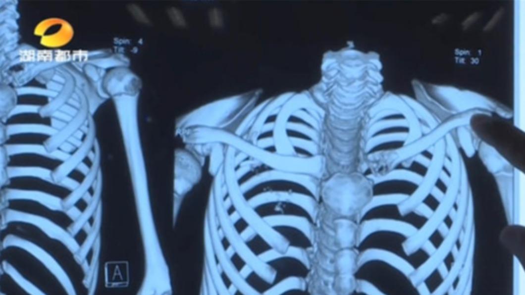 震驚！12歲男童「罹肺癌晚期」沒辦法救了　父母崩潰：「3生活習慣害的」