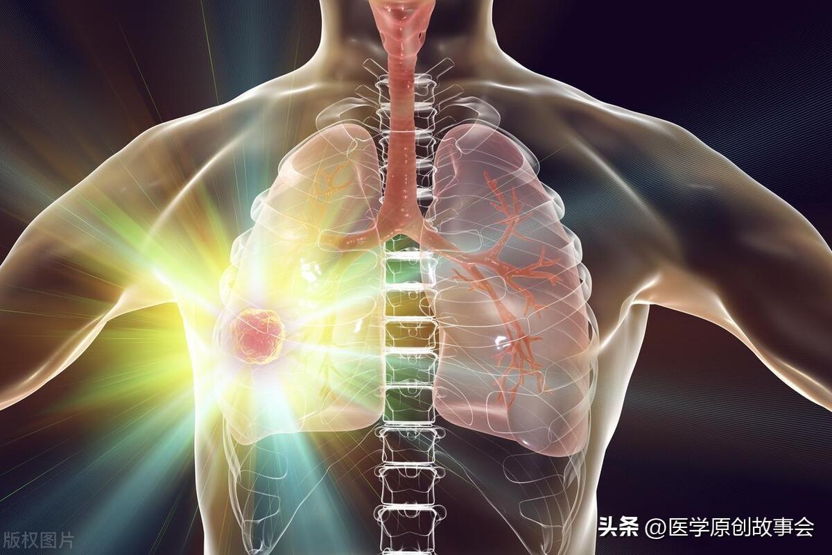 62歲女「手部早出現異樣」沒有多重視!1年後「已是肺癌晚期」 醫生提醒「有3種異常」要及時檢查肺部