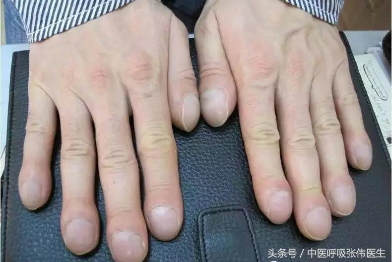 62歲女「手部早出現異樣」沒有多重視!1年後「已是肺癌晚期」 醫生提醒「有3種異常」要及時檢查肺部