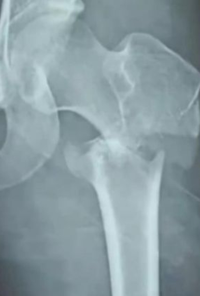 17歲學生「遭老師弄斷腿」舞蹈夢碎　對方冷回「只願賠22萬」：家屬太超過