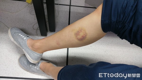 完全沒有症狀！女子做檢查「一數值怪怪的」竟罹癌　醫師悲嘆「精神好、沒有疲勞」：1年後就走了