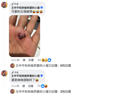 51歲余皓然「爆濺血意外」緊急送醫！公開最新傷勢「慘縫5針」原因曝光