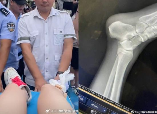 錄影爆意外！綜藝節目驚爆「2人重摔骨折」腳嚴重變形　他怒揭內幕：「節目組拒絕賠償」