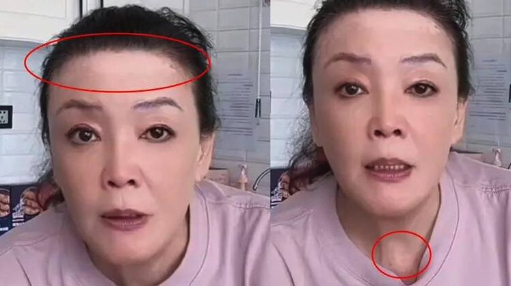 汪小菲剛再婚!67歲張蘭「驚傳臉部怪怪的」秒登熱搜 大方認了「罹患不治之症」只能靠藥物