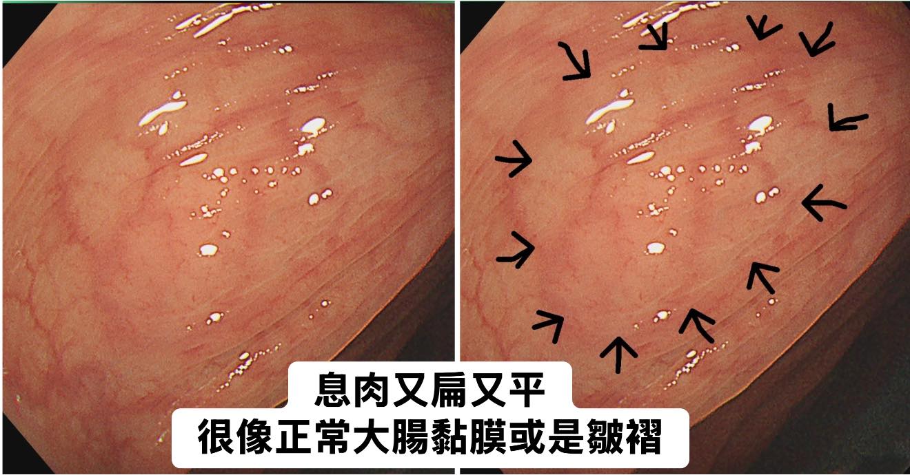 長期胃痛、脹氣！20歲女一照「息肉超過20顆」醫生嚇壞　示警「有強烈癌化風險」急做兩事保命