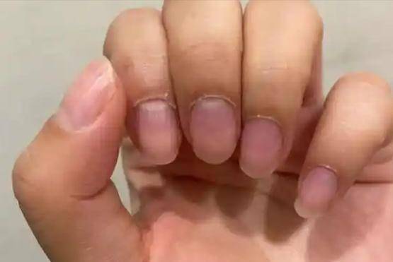 肝臟健康信號！醫生揭秘：手部無這3跡象，肝正在悄悄變好