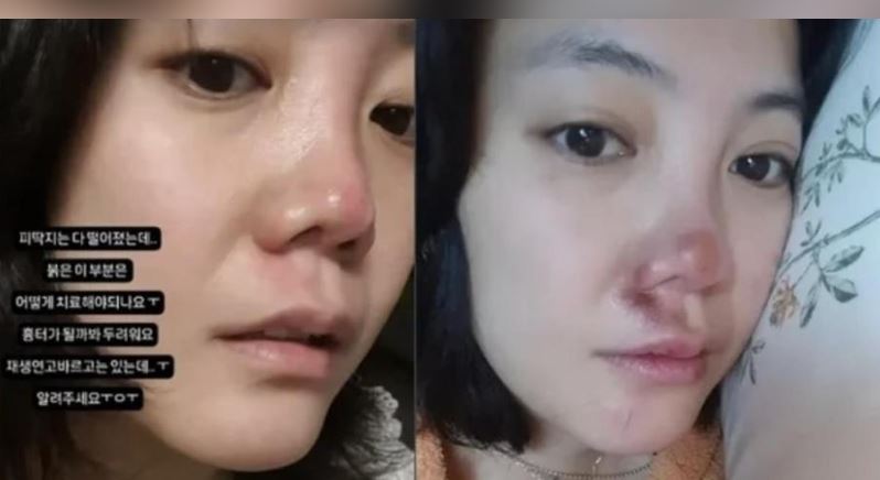 才砸80萬整鼻子！女星「街頭重摔慘毀容」驚人照曝光　網嚇傻「又要重整了....？」