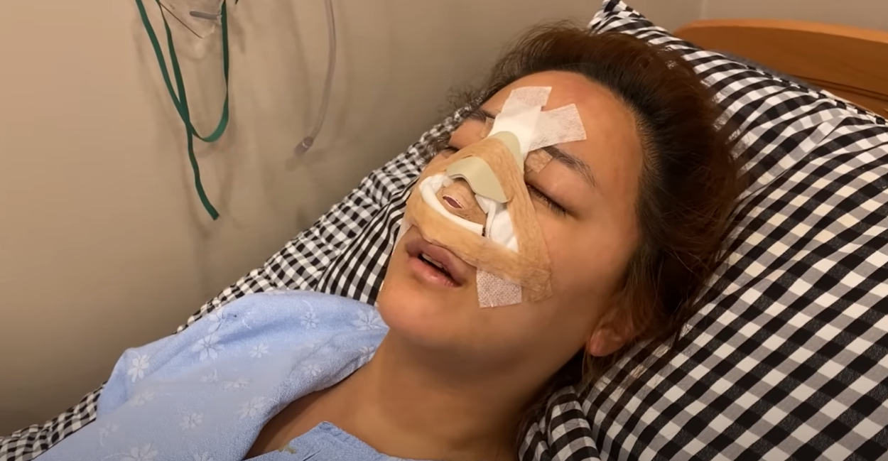 才砸80萬整鼻子！女星「街頭重摔慘毀容」驚人照曝光　網嚇傻「又要重整了....？」