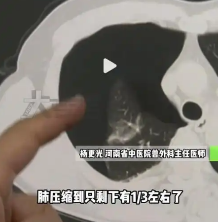 35歲男春節後狂運動 20下伏地挺身竟致「肺炸裂」醫：險喪命