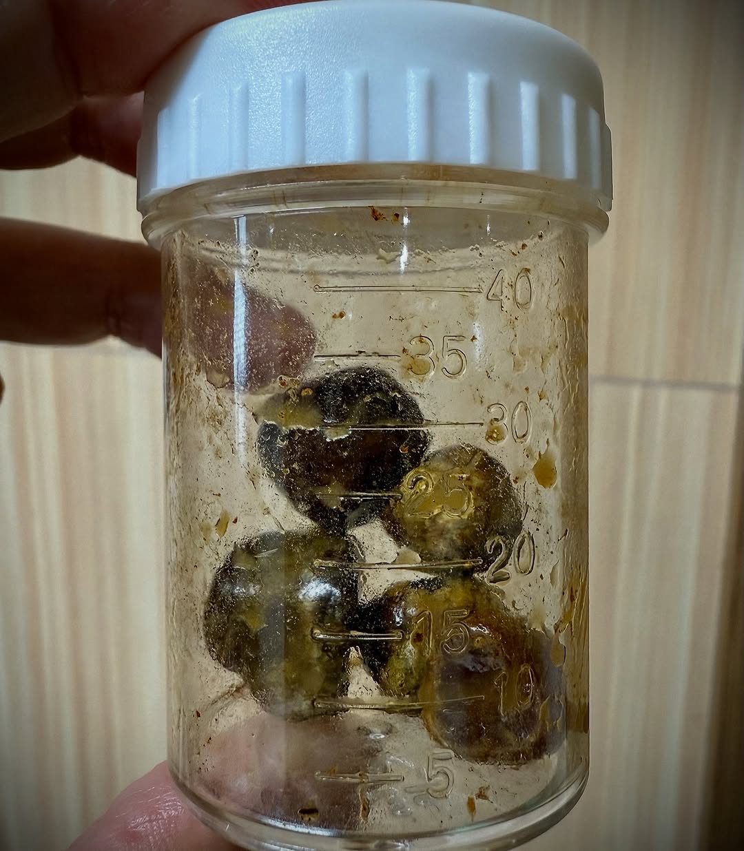 無預警住院動刀！46歲阿Ben「腹痛急診」認隱疾纏身　曬病榻照「取出5大顆」錯愕：塞滿了