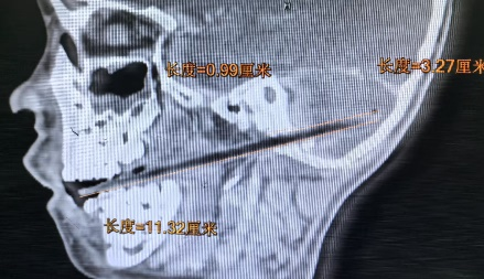 「吃麥芽糖」邊走邊吃！不慎跌倒「12cm竹籤」竟從嘴刺到顱底