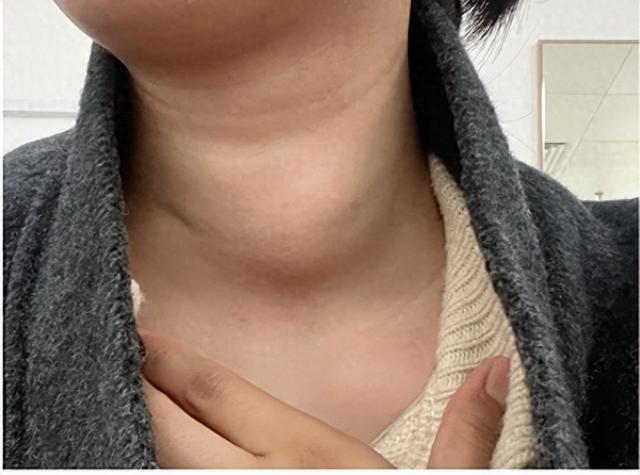 甲狀腺早期警訊不只脖子粗！醫師警告「這4大異常」勿輕忽，速就醫