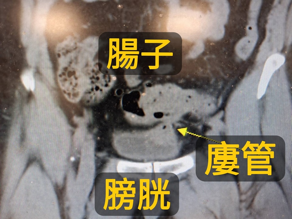 驚人病例！60歲男「泡泡尿」藏致命危機 醫驚見「腸道直通膀胱」急示警